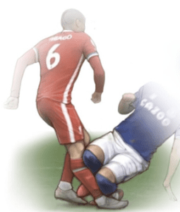 Strategies for Triumph: Rehabilitation and Return to Sport After ACL Injury | Hyperextension or contact mechanism of injury